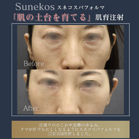 画像13600：ヒアルロン酸注入+糸リフト