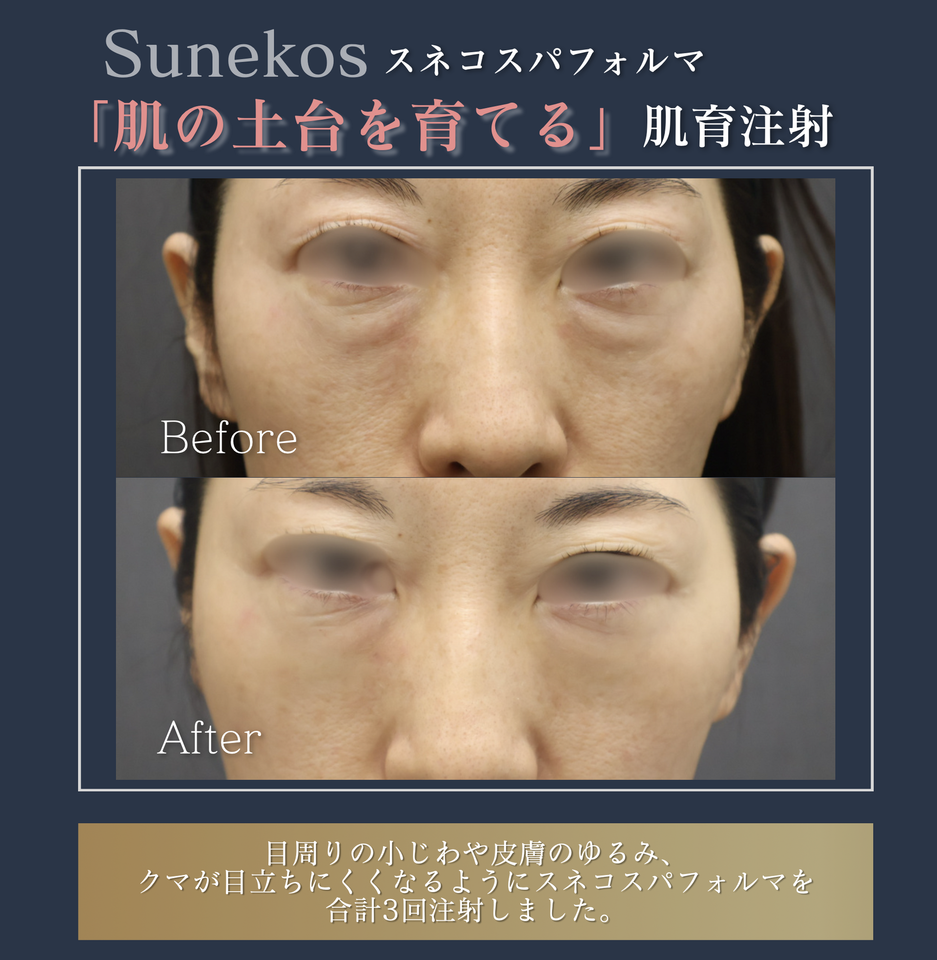 ヒアルロン酸注入+糸リフト