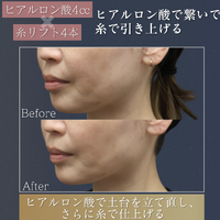 画像13602：ヒアルロン酸注入+糸リフト