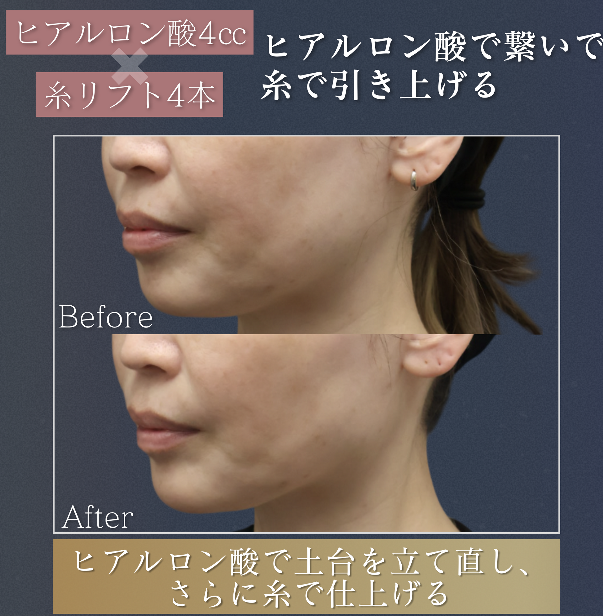 ヒアルロン酸注入+糸リフト