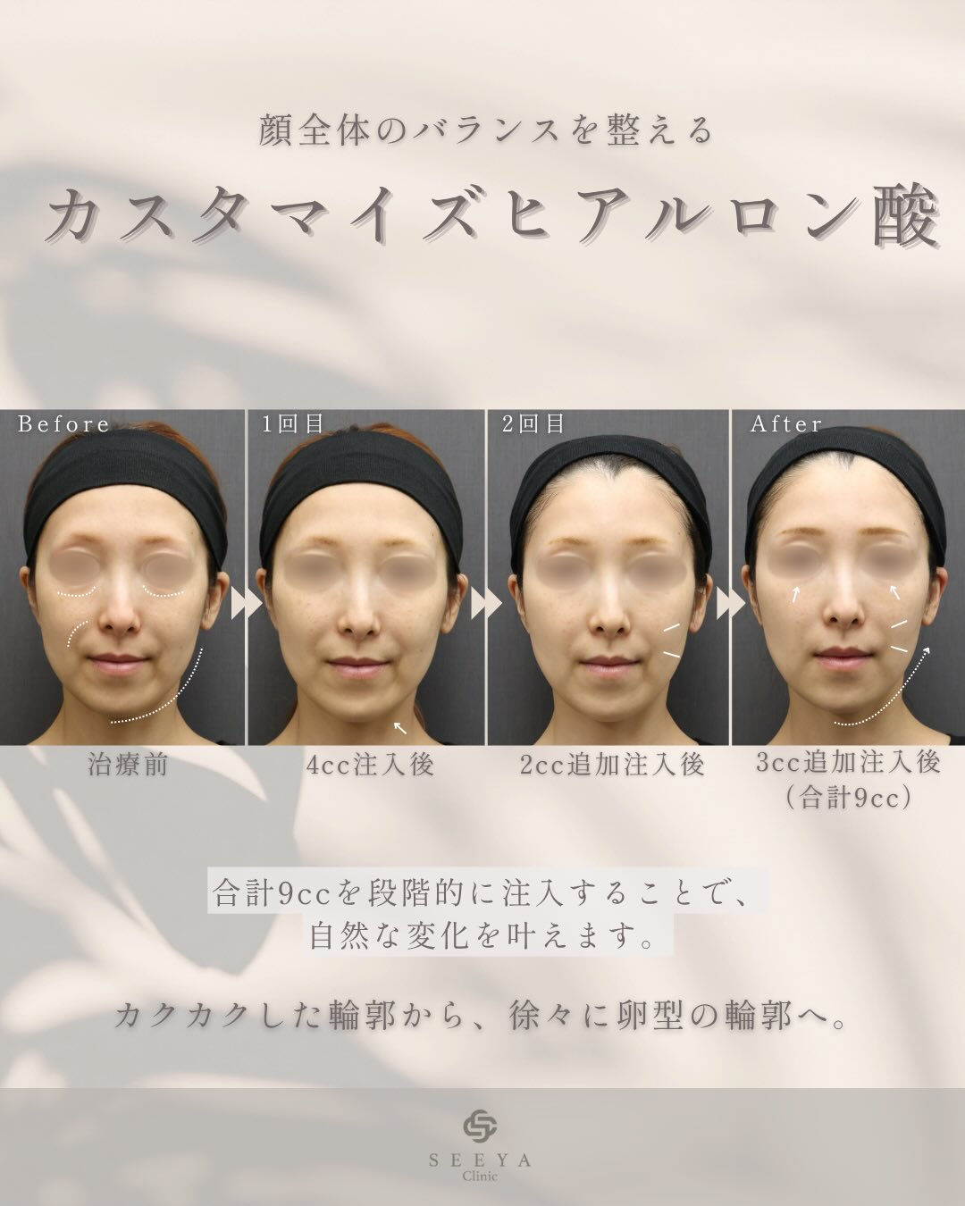 【段階的に美しく顔全体のバランスを整える、カスタマイズヒアル