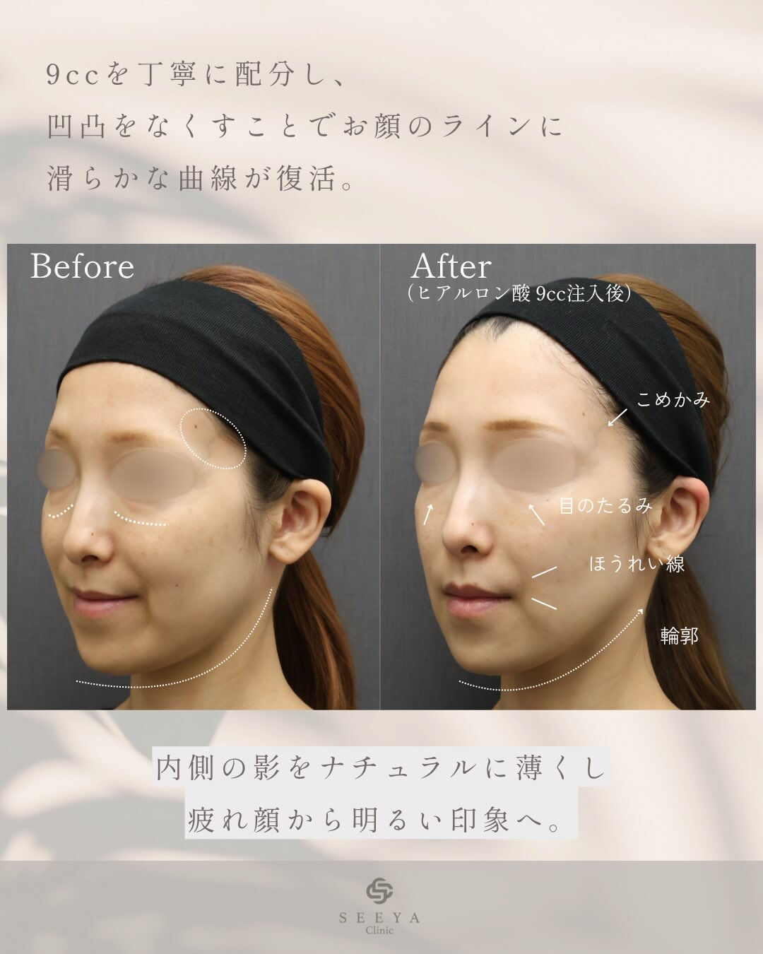【段階的に美しく顔全体のバランスを整える、カスタマイズヒアル