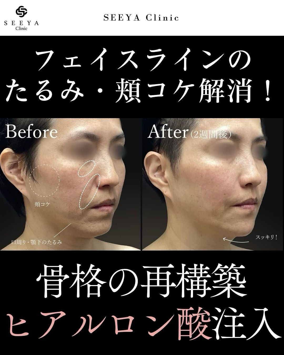 【骨格を整えるカスタマイズヒアルロン酸注入💉】
