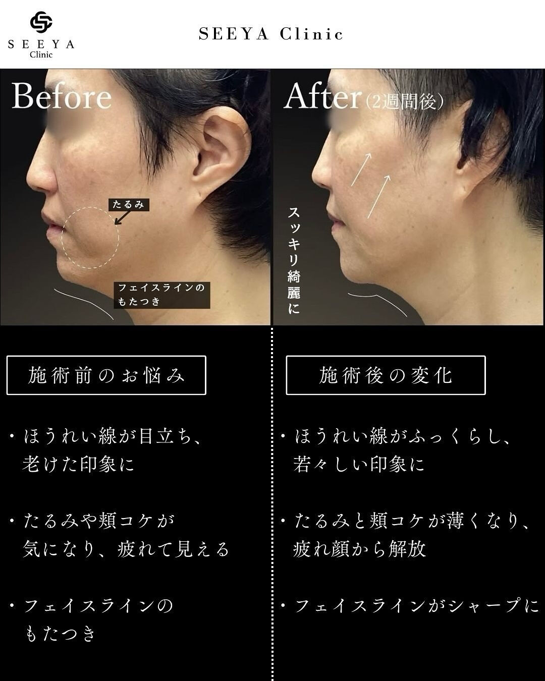 【骨格を整えるカスタマイズヒアルロン酸注入💉】