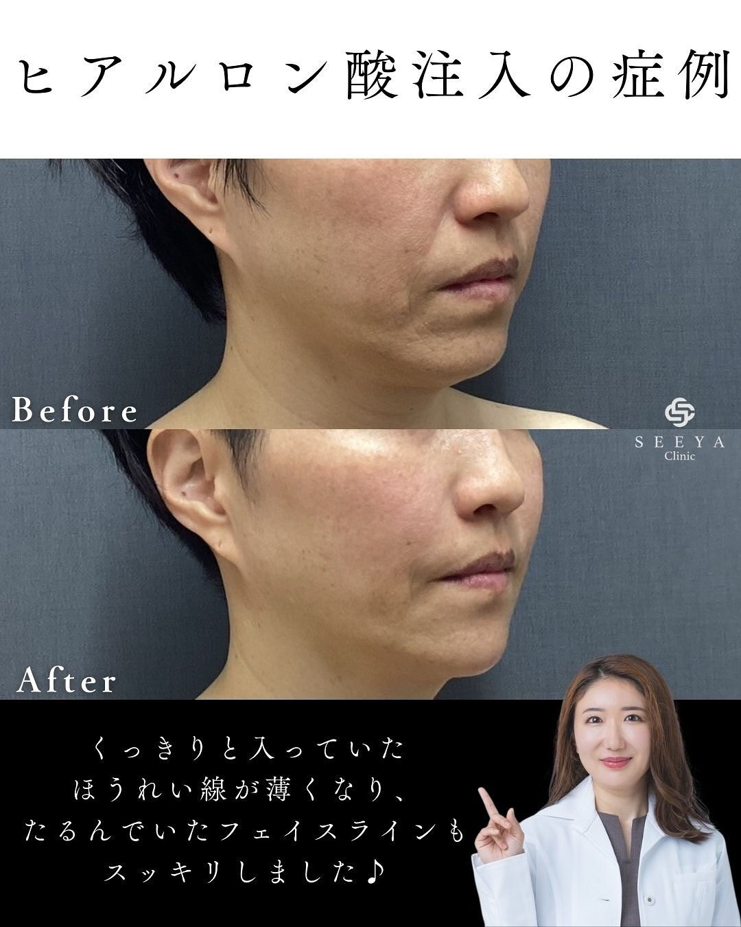 【骨格を整えるカスタマイズヒアルロン酸注入💉】