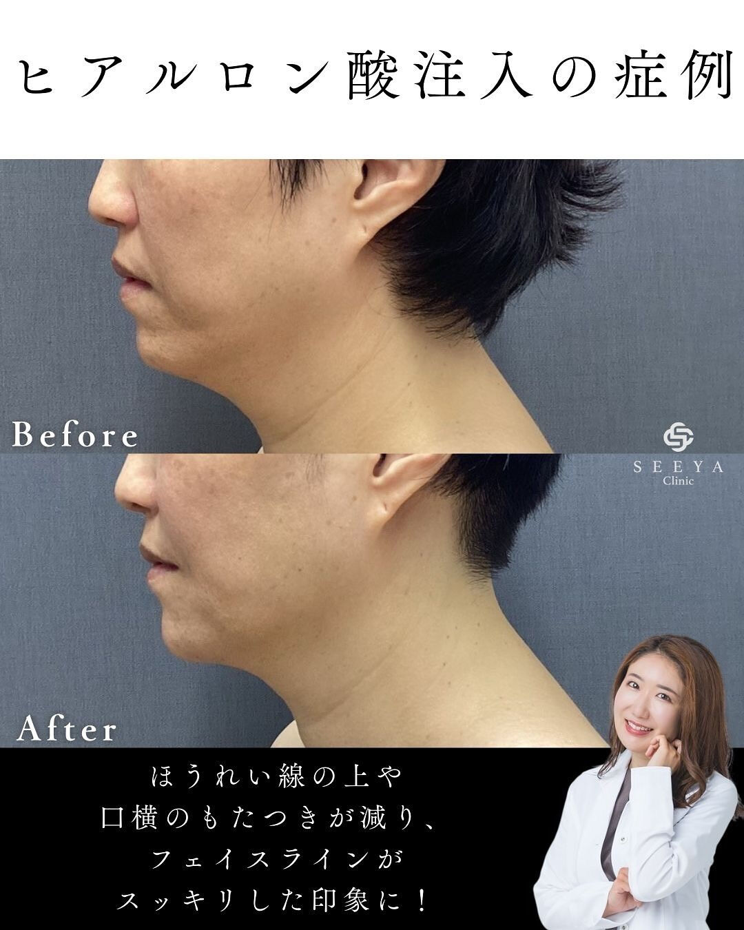 【骨格を整えるカスタマイズヒアルロン酸注入💉】