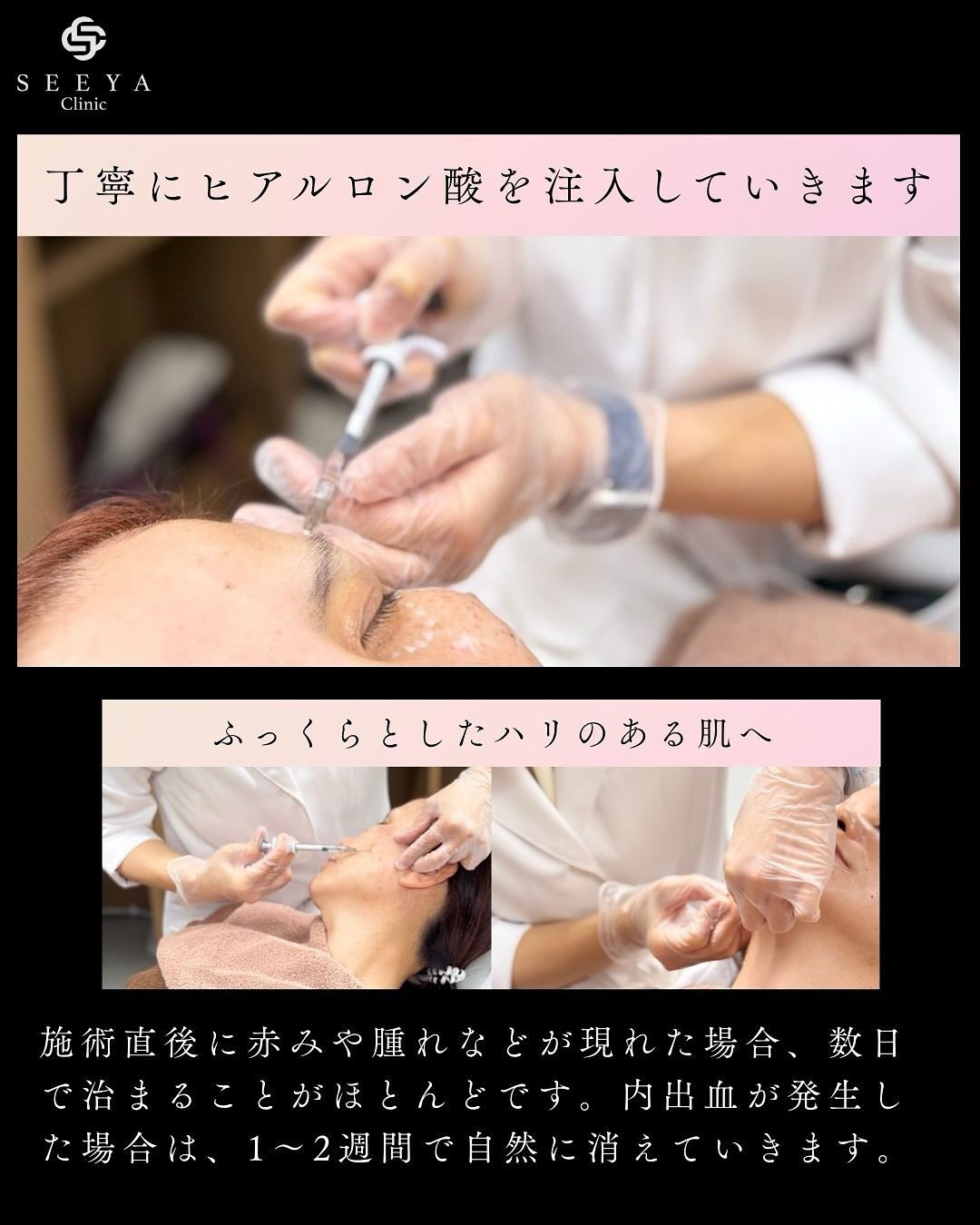 【骨格を整えるカスタマイズヒアルロン酸注入💉】