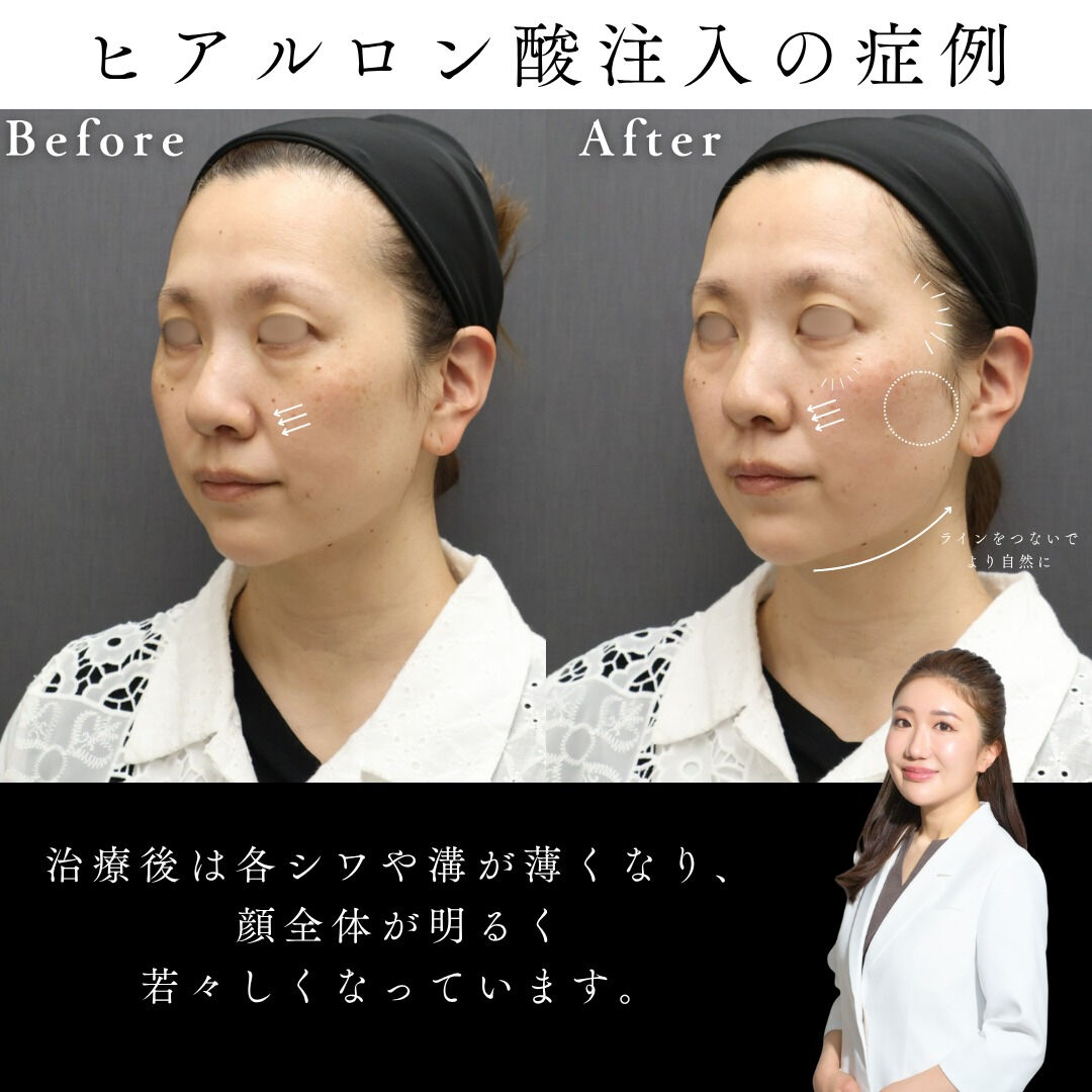 【ヒアルロン酸リフト 症例】