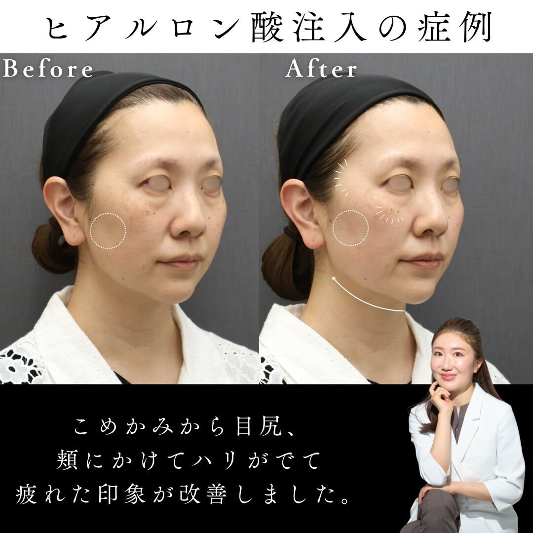 【ヒアルロン酸リフト 症例】