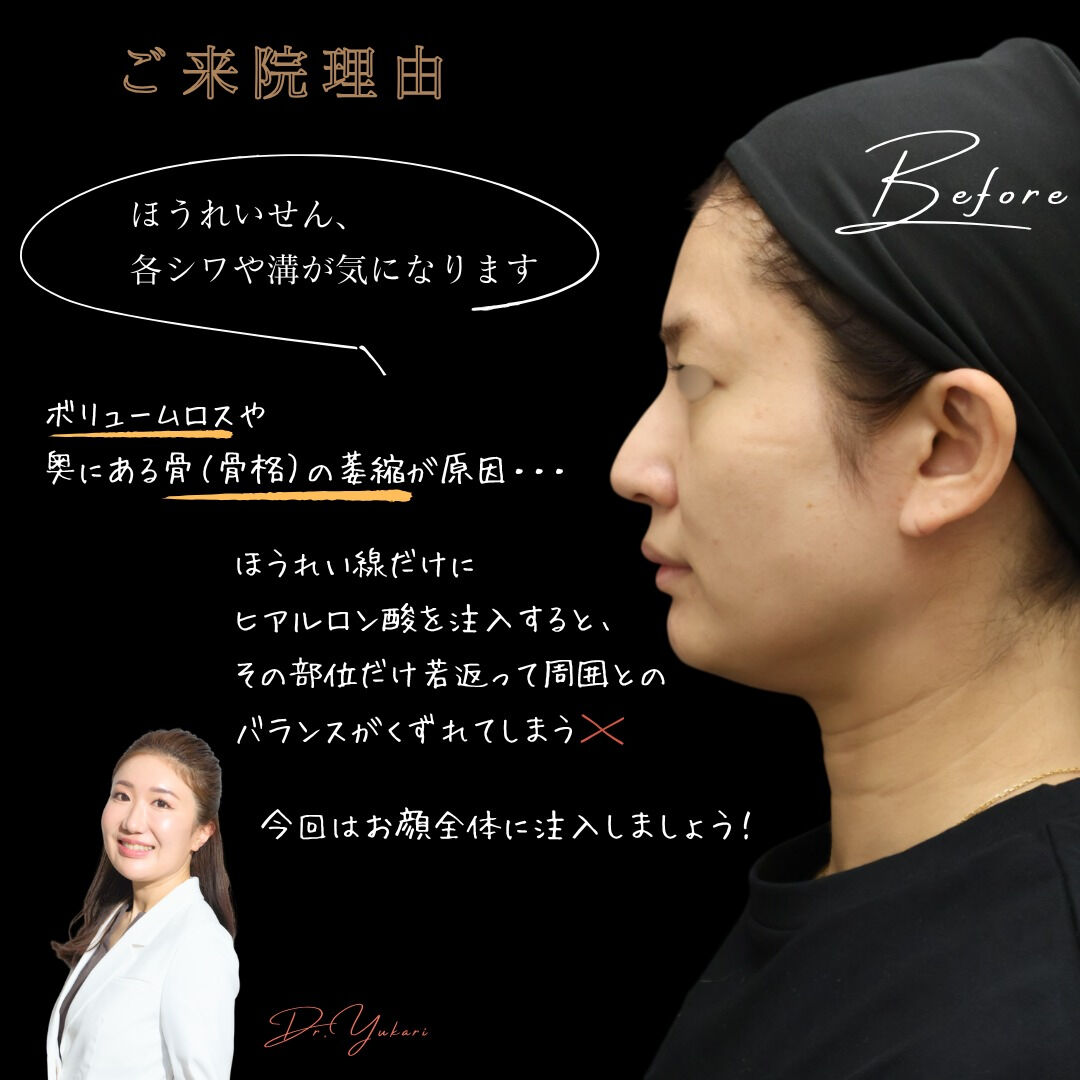 【ヒアルロン酸リフト 症例】