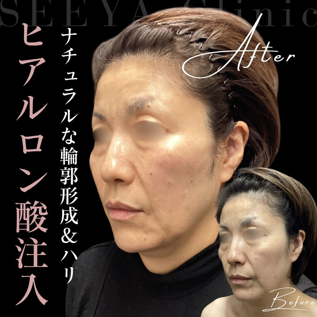 【ヒアルロン酸注入の魅力】