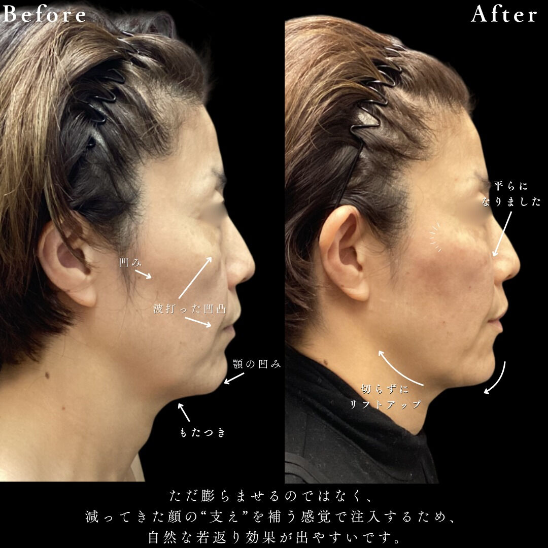 【ヒアルロン酸注入の魅力】