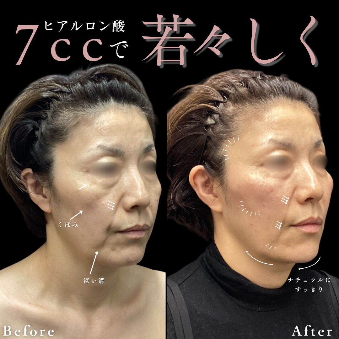 【ヒアルロン酸注入の魅力】