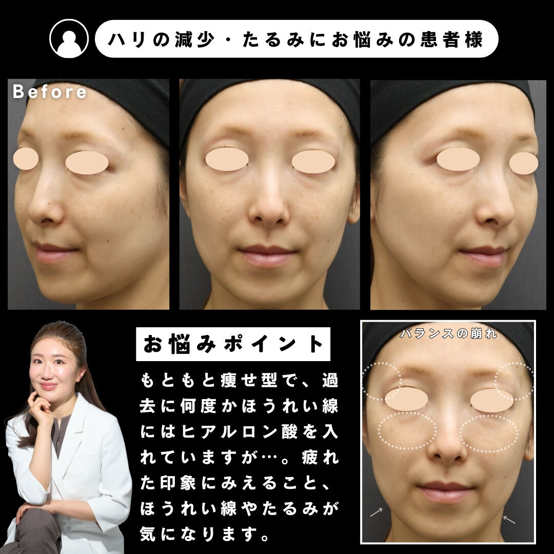 「最近、頬やフェイスラインのたるみが気になる…」