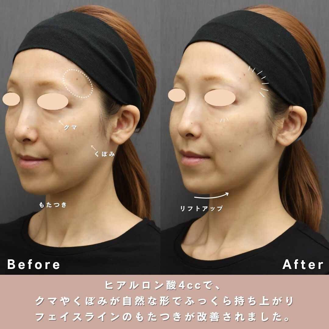 「最近、頬やフェイスラインのたるみが気になる…」