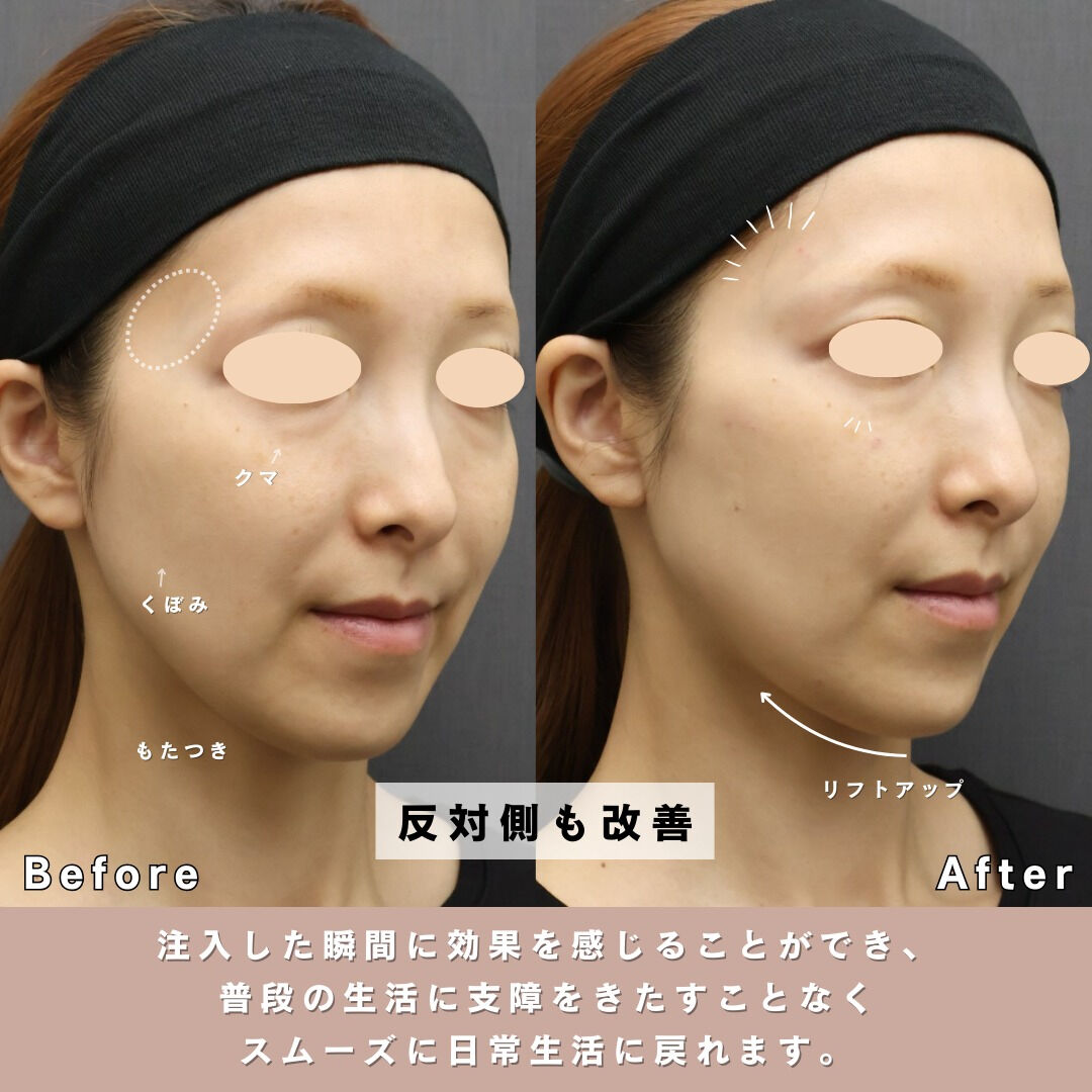 「最近、頬やフェイスラインのたるみが気になる…」