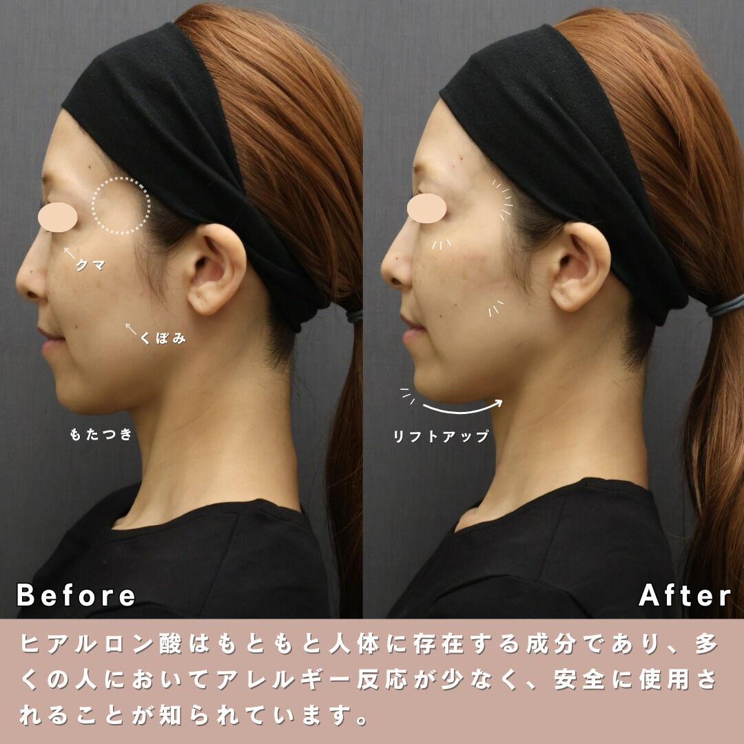 「最近、頬やフェイスラインのたるみが気になる…」