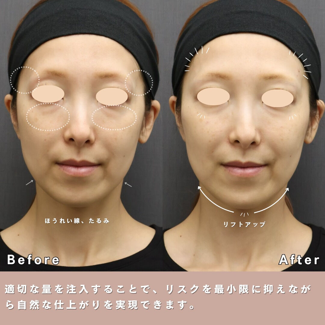 「最近、頬やフェイスラインのたるみが気になる…」