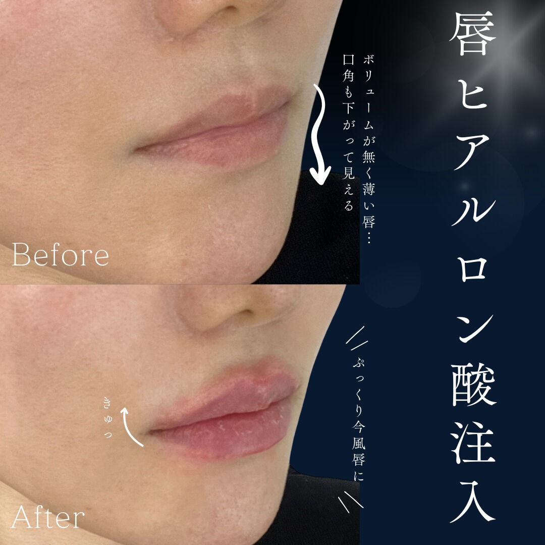 👄ヒアルロン酸で叶える“ぷっくりリップ”✨