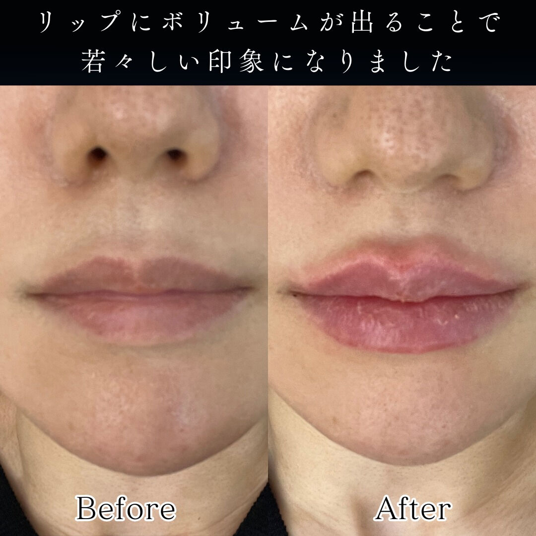 👄ヒアルロン酸で叶える“ぷっくりリップ”✨