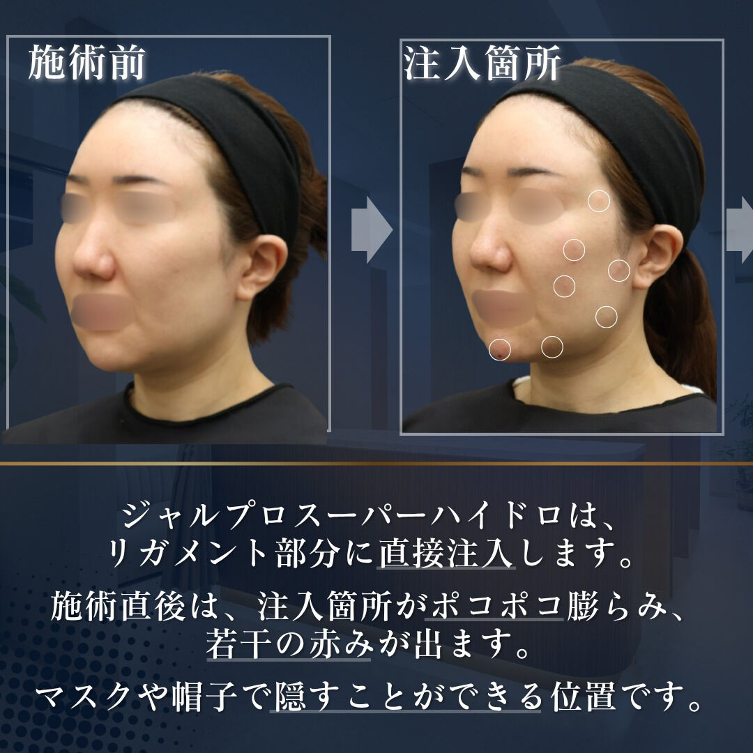 ⚪ジャルプロで叶える ダウンタイムの少ない自然なリフトアップ