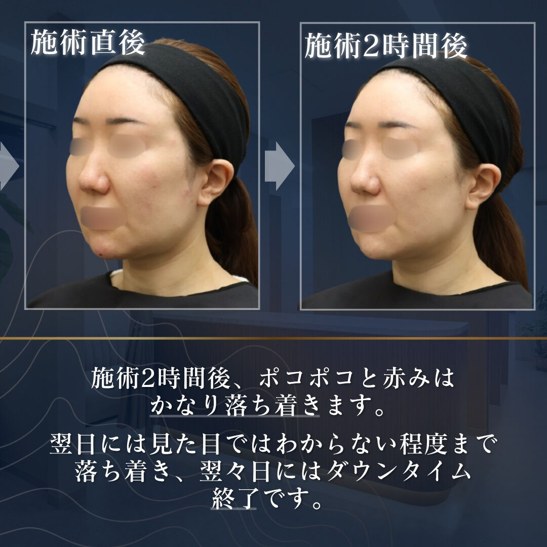 ⚪ジャルプロで叶える ダウンタイムの少ない自然なリフトアップ