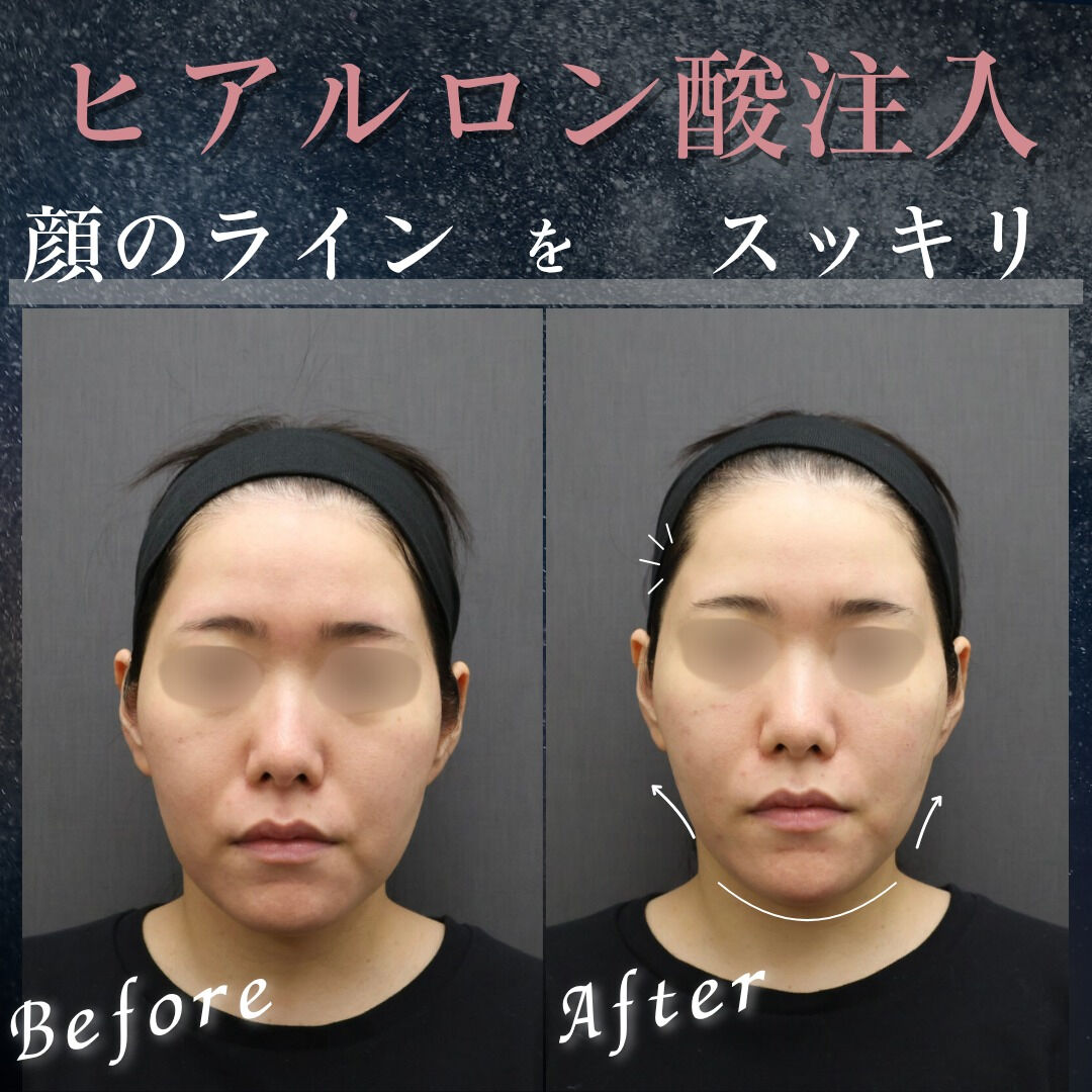 輪郭スッキリ✨ヒアルロン酸で顔の外枠をデザイン！