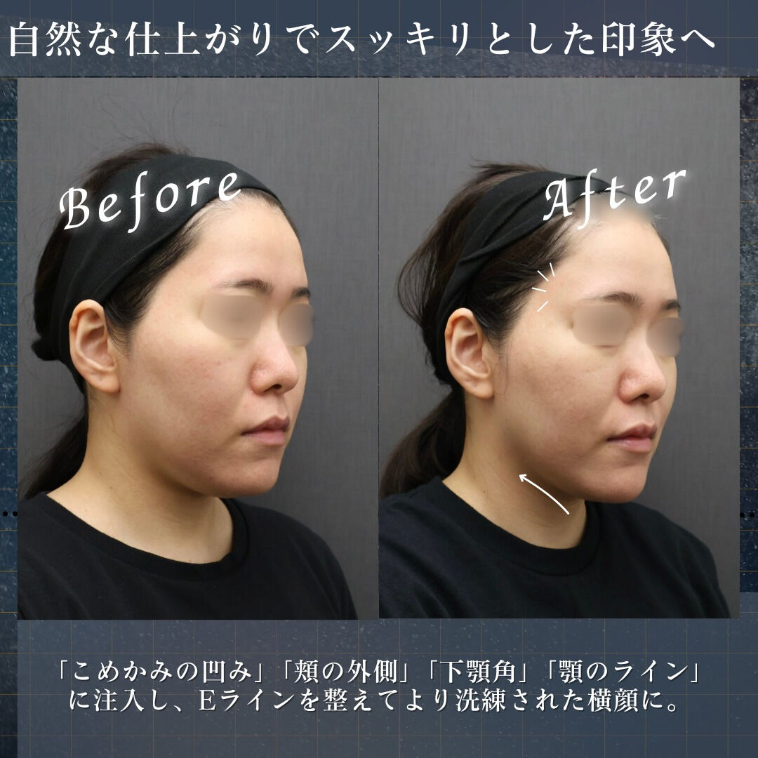 輪郭スッキリ✨ヒアルロン酸で顔の外枠をデザイン！