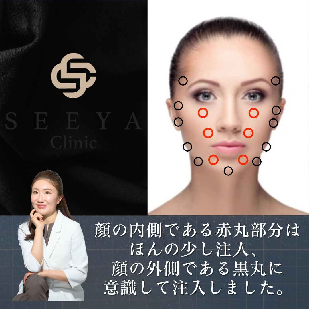 輪郭スッキリ✨ヒアルロン酸で顔の外枠をデザイン！