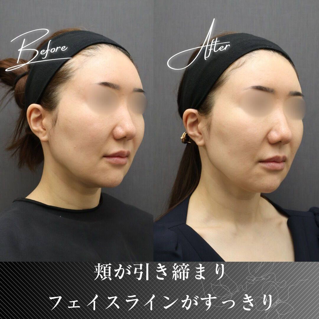 ボルニューマーは、独自開発された4種類のチップ（目元専用、ボ