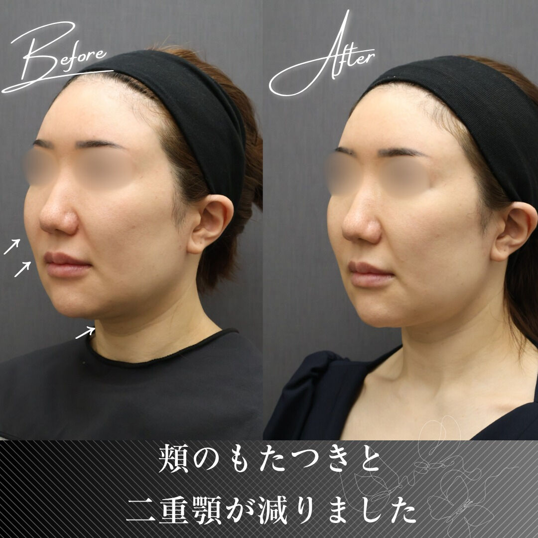 ボルニューマーは、独自開発された4種類のチップ（目元専用、ボ