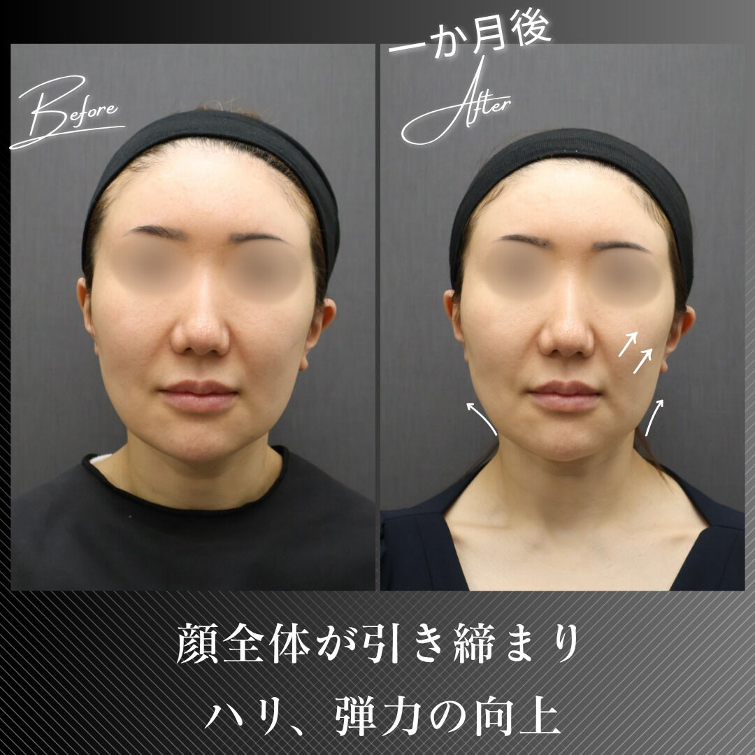 ボルニューマーは、独自開発された4種類のチップ（目元専用、ボ
