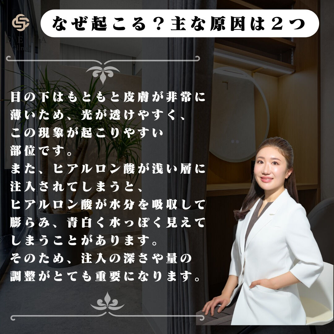 ヒアルロン酸で起こることがある “チンダル現象” をご存じで