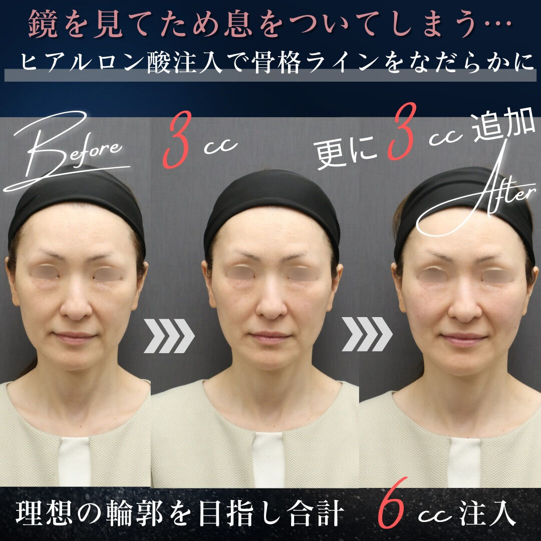 【ビフォーアフター公開】お顔全体のバランス美を追求！ヒアルロ