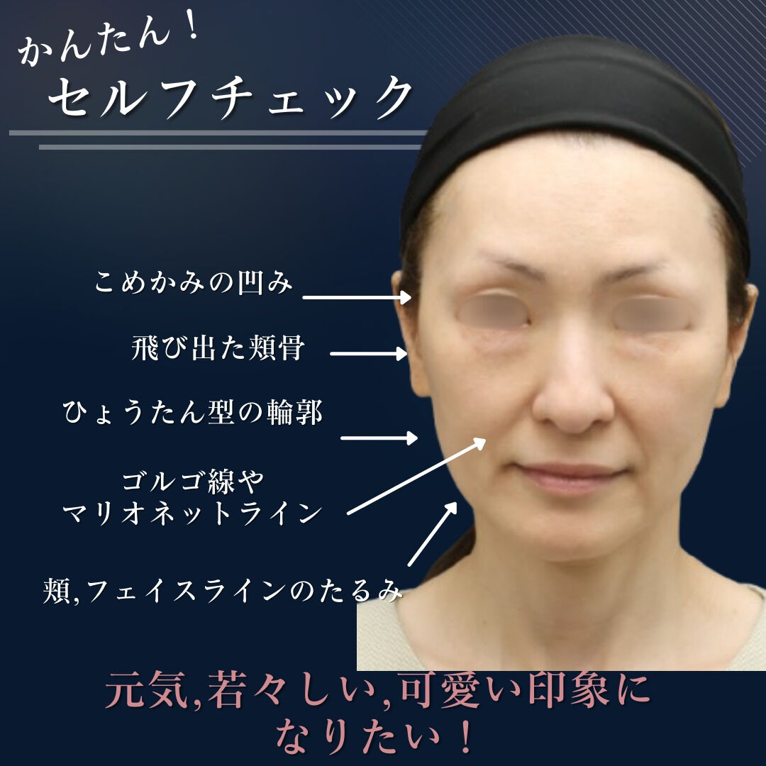 【ビフォーアフター公開】お顔全体のバランス美を追求！ヒアルロ