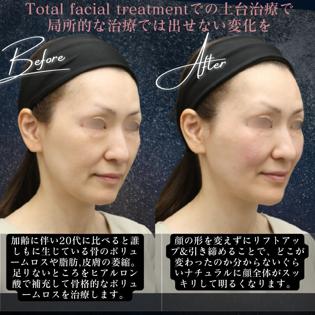 【ビフォーアフター公開】お顔全体のバランス美を追求！ヒアルロ