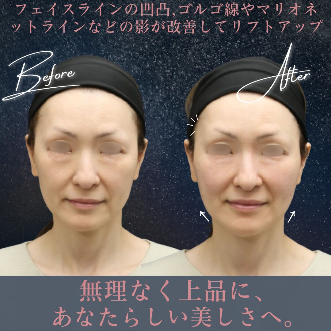 【ビフォーアフター公開】お顔全体のバランス美を追求！ヒアルロ