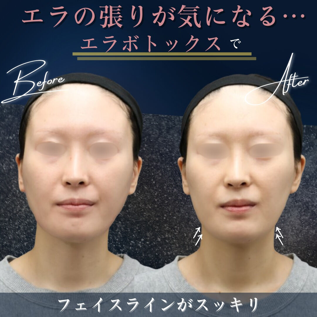 【上質な美を追求する方へ】フェイスラインを整えるエラボトック