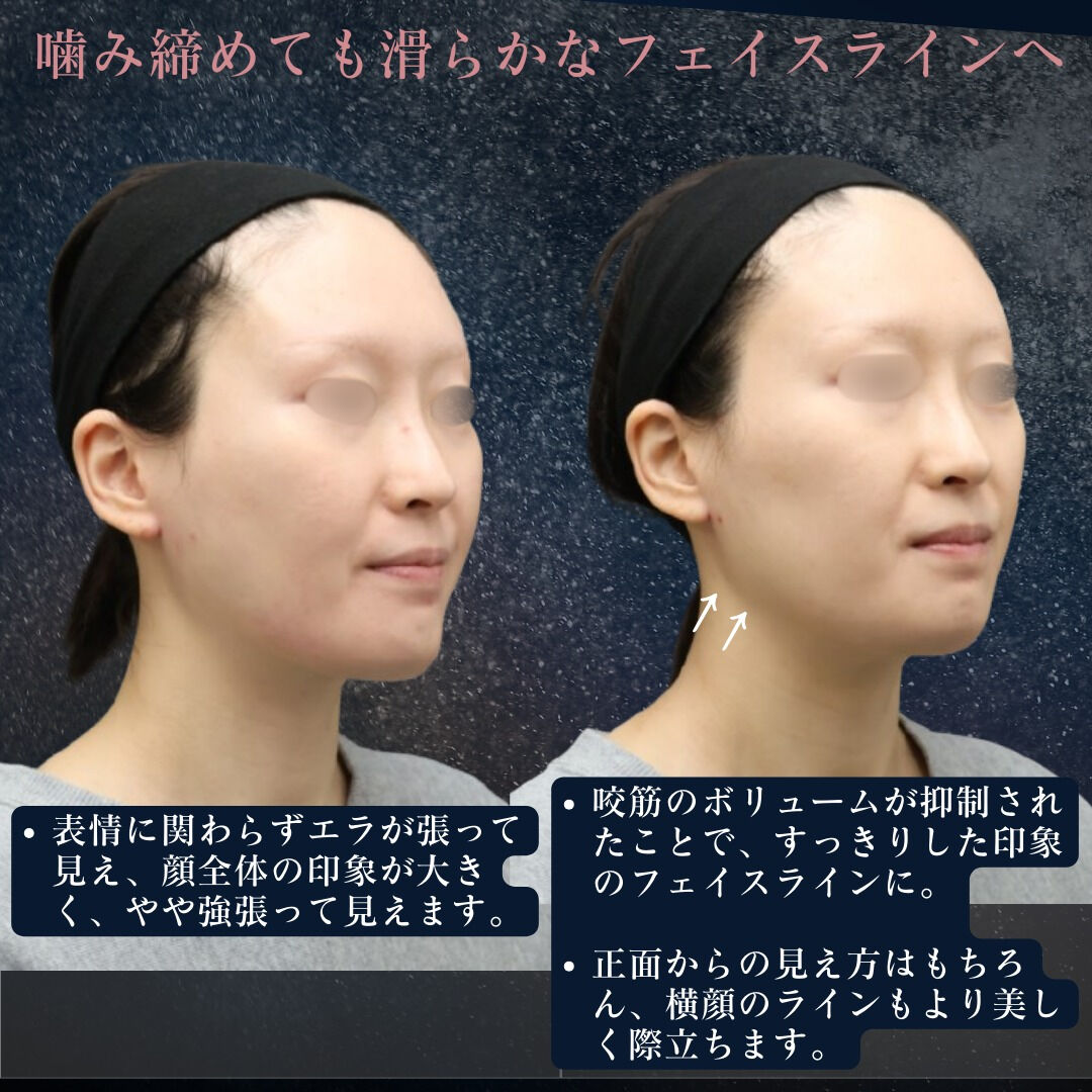 【上質な美を追求する方へ】フェイスラインを整えるエラボトック
