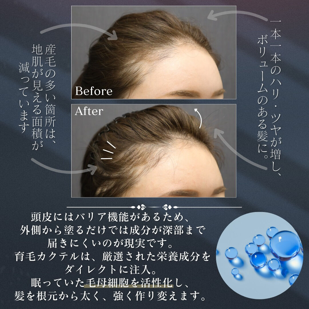 《育毛カクテル注射とは？》